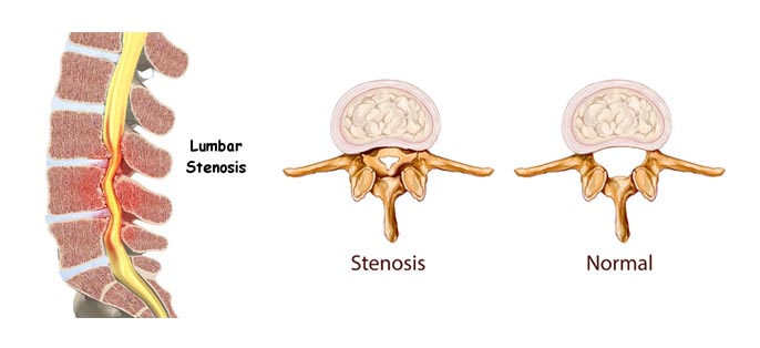 lumbar-canal-stenosis